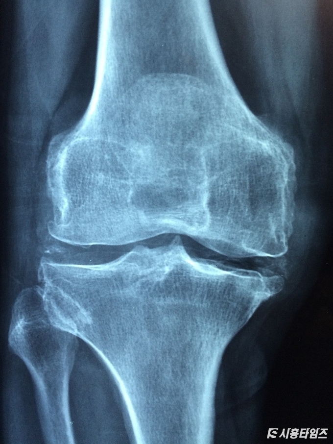 New Guidelines for Osteoporosis Prevention and Management Released in Korea